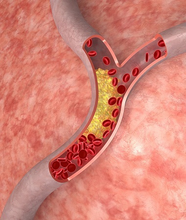 image of cholesterol artery
