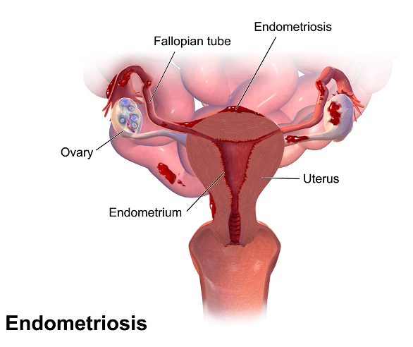 Endometriosis illustration