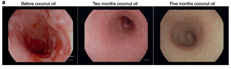 https://coconutoil.com/wp-content/uploads/sites/6/2018/10/images-of-the-rectum.jpg